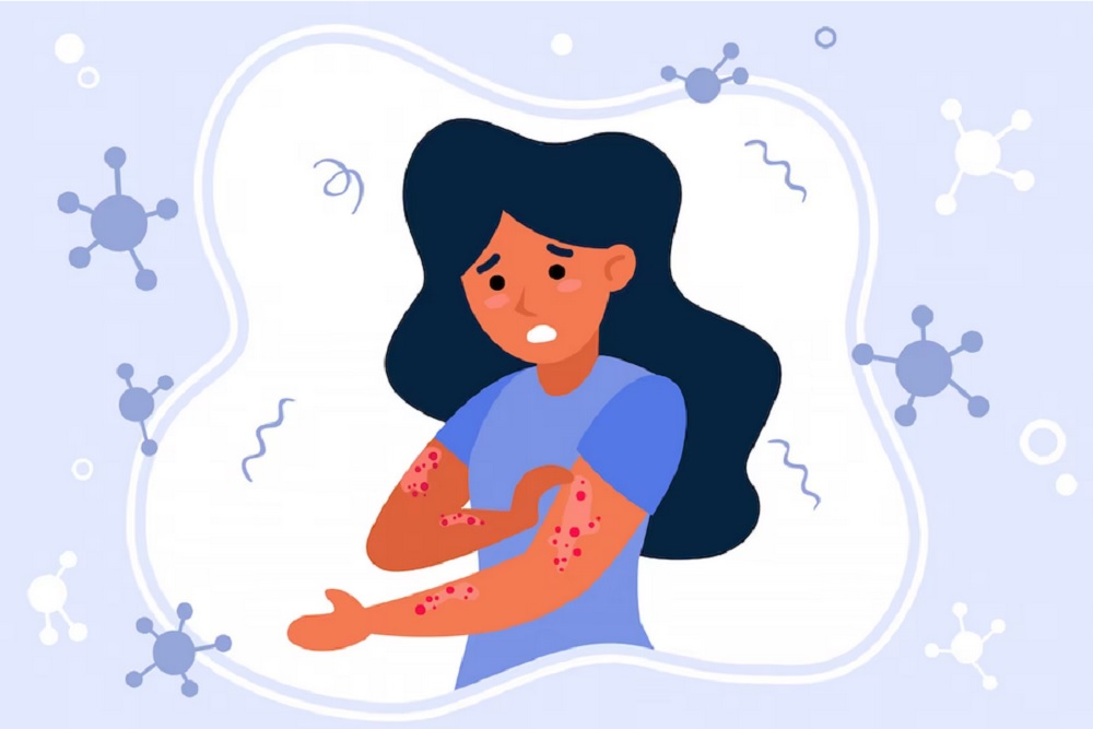 Kasus Leptopirosis di Kota Jogja Melonjak, Dinkes DIY: Kalau Ada Gejala Segera Periksa