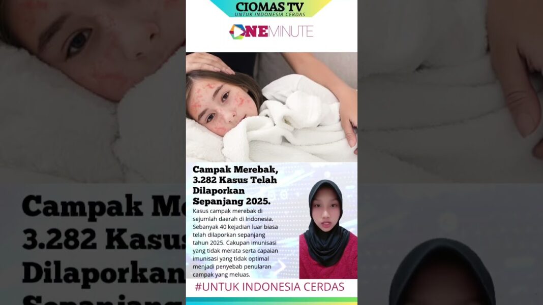 Kasus Campak Merebak, Ini Cara Penanganan Awal di Rumah