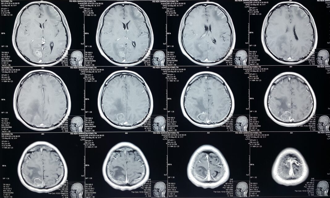 Laki-laki Fit Kena Stroke Lakunar, Lumpuh Setengah Badan gegara Minuman Energi